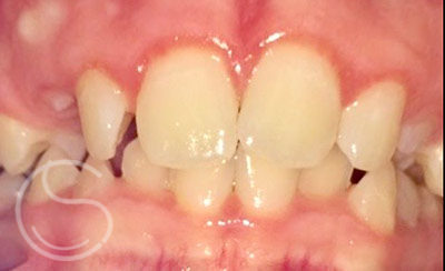 Orthodontics before photo